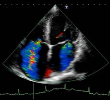 Doppler Echocardiogram