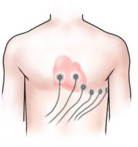 Electrocardiogram (EKG)