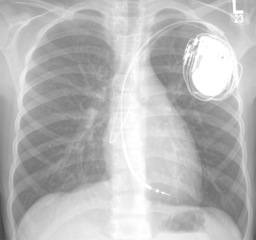 Implantable Cardioverter Defibrillator (ICD) Analysis